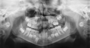 Dental Radiographs (X-Rays) - Pediatric Dentist in Memphis, TN